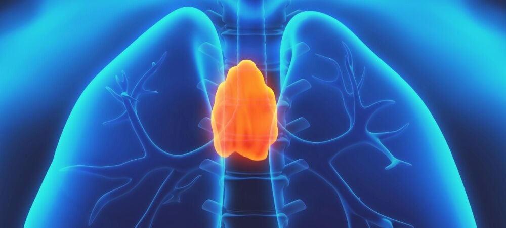 Timüs Bezi Kanseri2