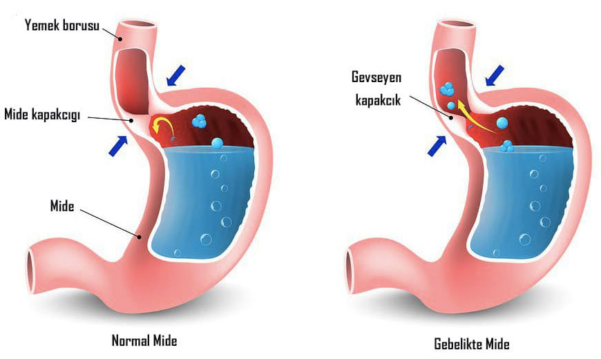 Hamileleikte Mide Yanması