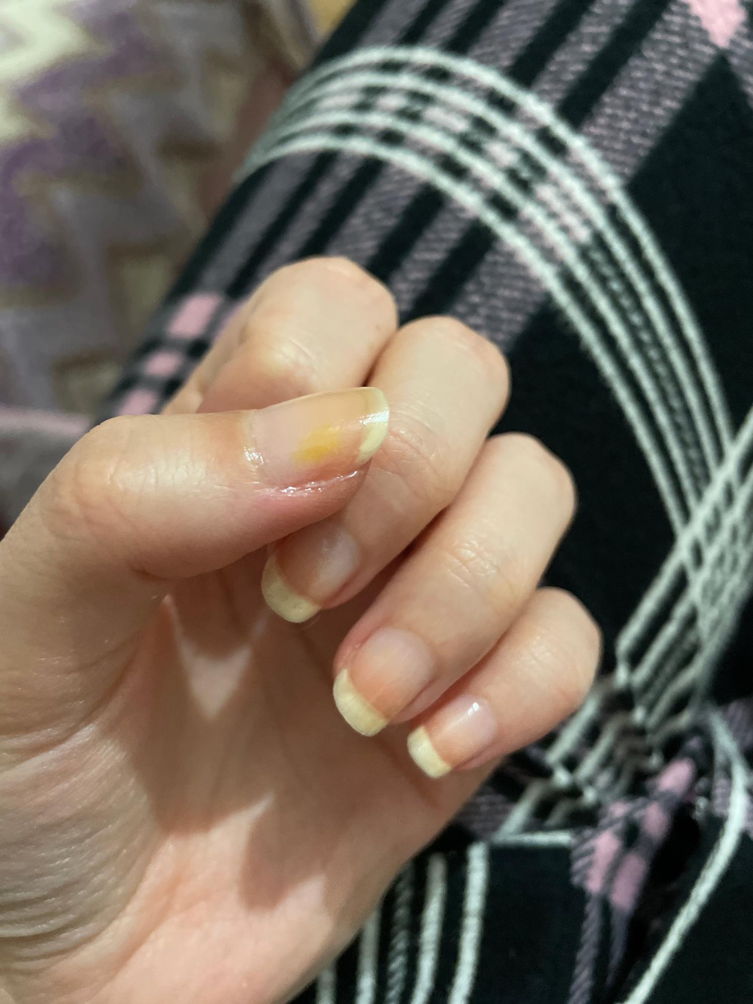 Tırnakta Sarı Leke