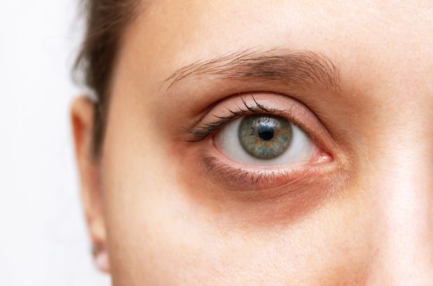 Göz Altı Morluğu2