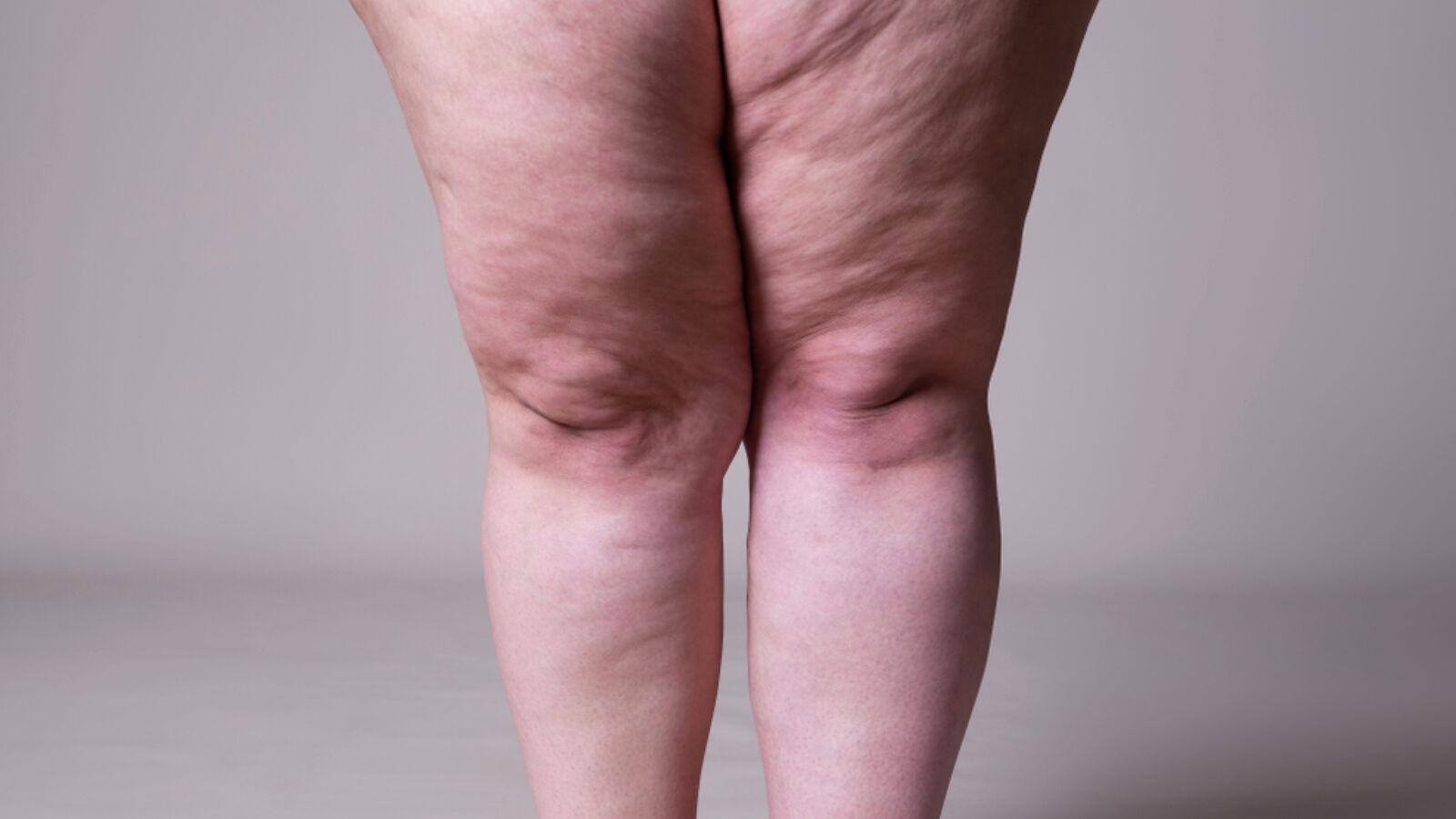 Lipodem Nedir (1)-1