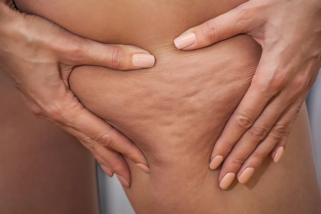 Lipodem Nedir (1)