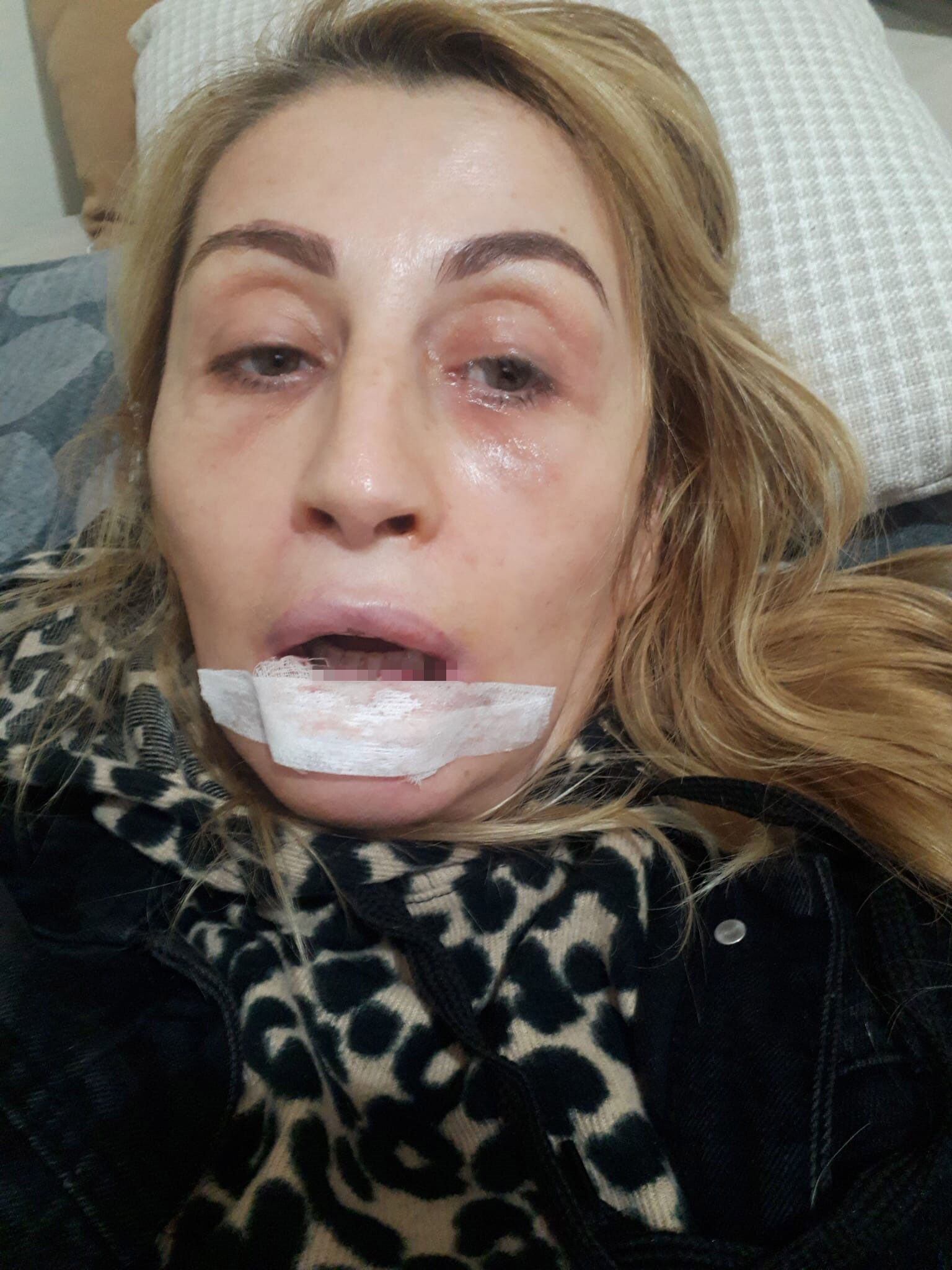Dudağındaki Doku Kaybı Için 7 Yıldır Adalet Arıyor (1)